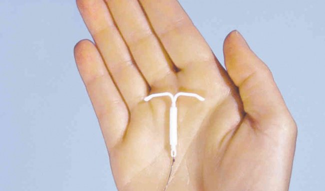 Vòng giảm thiểu thai (IUD) là gì?