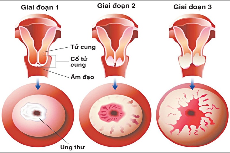 20230130 ung thu co tu cung giai doan 1 7