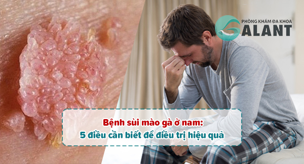 sùi mào gà ở nam