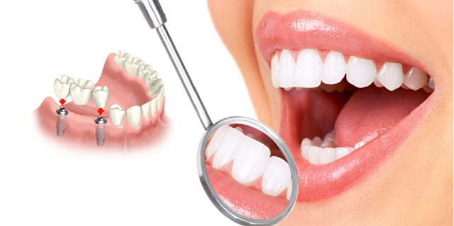 Bạn hãy đến phòng khám đa khoa Galant khi cần cấy ghép răng implant