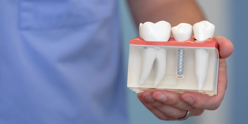 Bạn nên biết cấy ghép răng implant là gì, có giải quyết vấn đề răng của mình không?