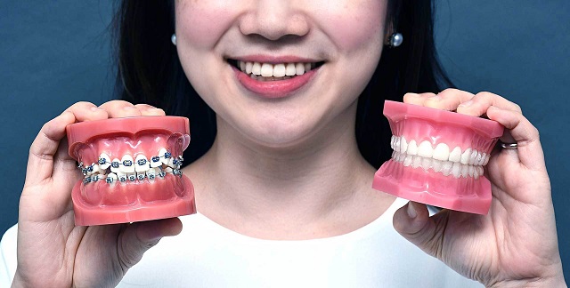 Bạn nên chủ động tìm hiểu niềng răng là gì?