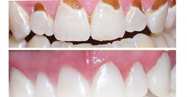 Bảo vệ hàm răng chắc khỏe thông qua cách trám răng bị mẻ