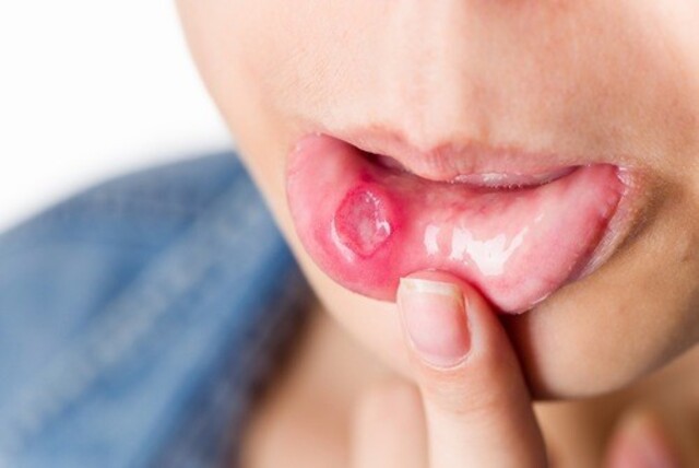 Bệnh giang mai ở miệng có làm tăng nguy cơ bị HIV không?