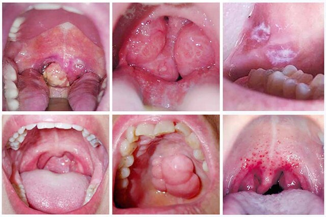 Bị lở loét ở khu vực trong miệng, lưỡi, viêm họng là dấu hiệu của giang mai ở miệng
