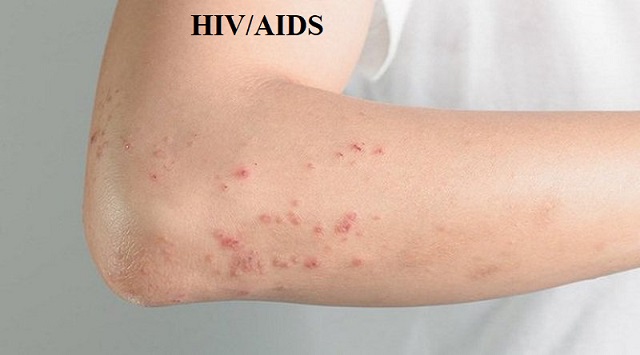 Biểu hiện của HIV là gì?