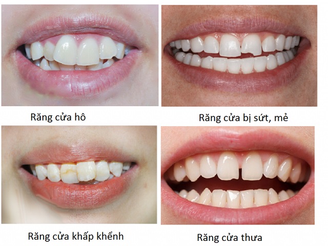 Bọc răng sứ giá bao nhiêu sẽ phụ thuộc vào tình trạng hàm răng
