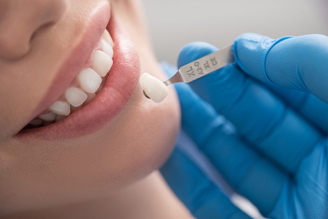 Bọc răng sứ giúp khắc phục những khuyết điểm của hàm răng