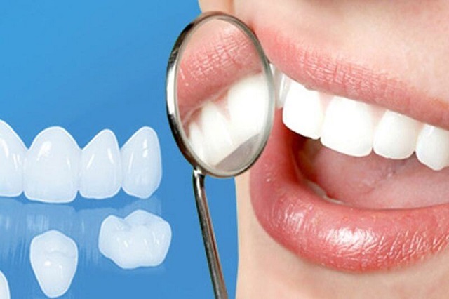 Bọc răng sứ kim loại