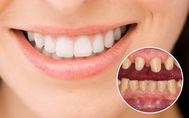 Bọc răng sứ thẩm mỹ đem lại một hàm răng đẹp, trắng sáng và đều