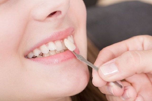 Bọc sứ răng cửa là gì?