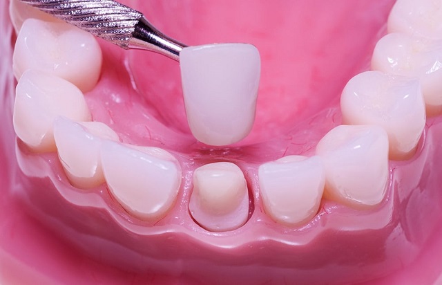 Bọc sứ răng là gì? Ai nên bọc sứ răng?