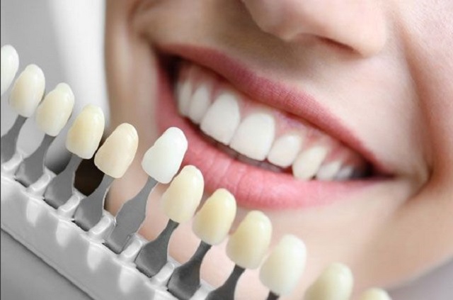 Bọc sứ răng tốn bao nhiêu chi phí?