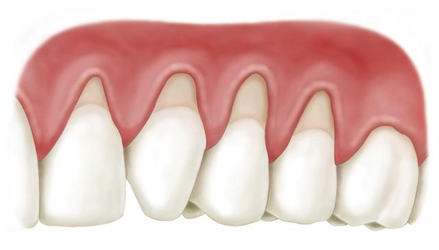 Các dấu hiệu mà bạn cần biết về tụt chân răng