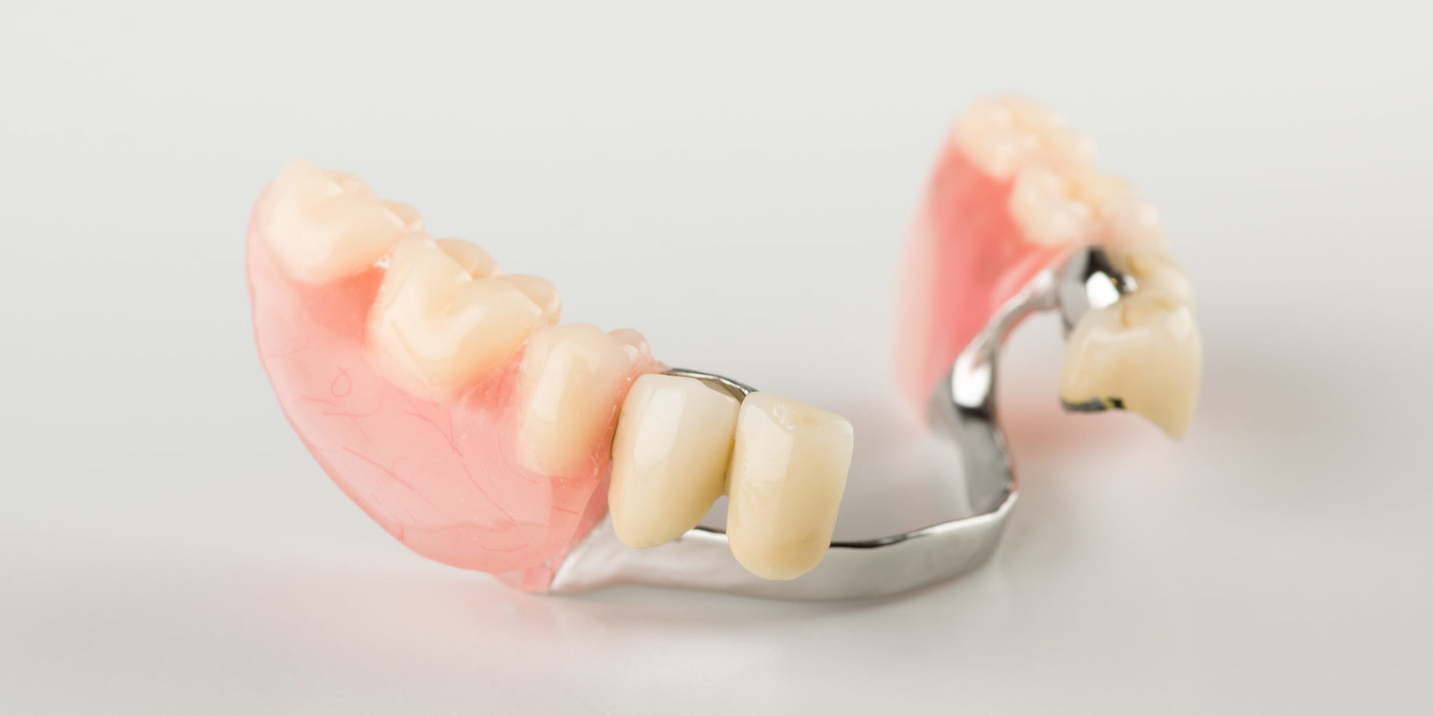 Các loại hàm răng giả có gắn khung kim loại khá chắc chắn.