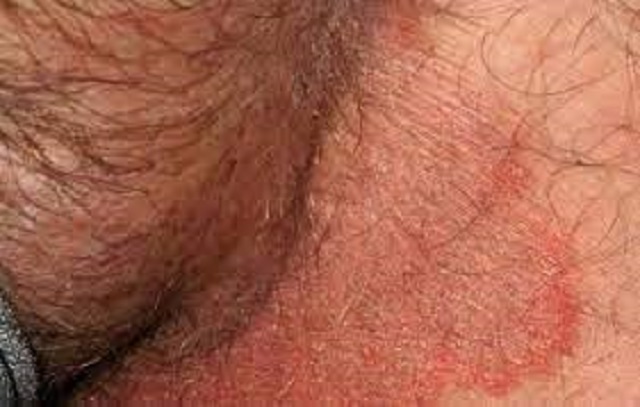 Các triệu chứng thường gặp khi nam giới bị nhiễm nấm sinh dục