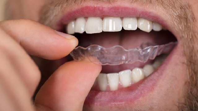 Cách tẩy trắng răng tại nhà giúp tiết kiệm chi phí hiệu quả