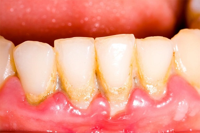 Cạo vôi răng là việc cần thực hiện giúp bảo vệ răng miệng trước các bệnh lý