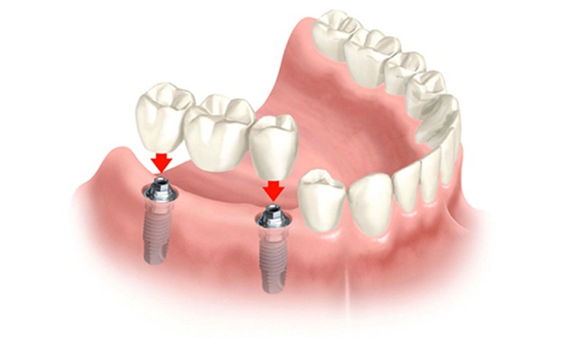 Cấy ghép implant là một phương pháp nha khoa có tác dụng phụ hồi răng bị mất