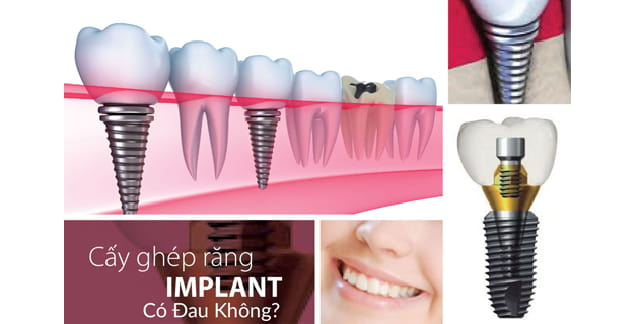 Cấy ghép răng implant không đau khi thực hiện