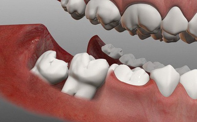 Chi phí nhổ răng khôn phụ thuộc vào rất nhiều yếu tố khác nhau