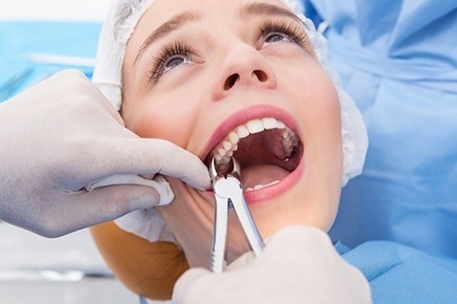 Chi phí nhổ răng sẽ được bác sĩ thông báo chính xác sau quá trình thăm khám