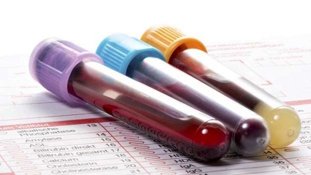 Chi phí xét nghiệm máu tổng quát có đắt không?