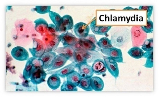 Chlamydia trachomatis là tên của loại vi khuẩn có thể gây ra bệnh nấm Chlamydia