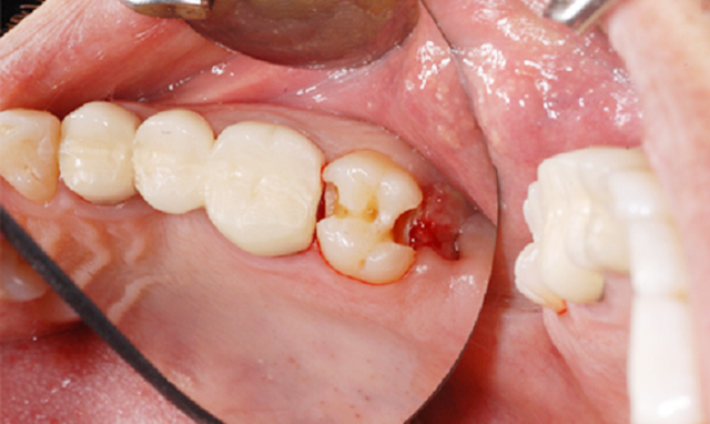 Chữa tủy răng có thể chữa khỏi sau 1 lần?
