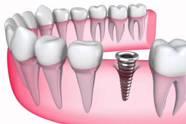 Có nên cấy ghép răng implant không? – Câu trả lời là có