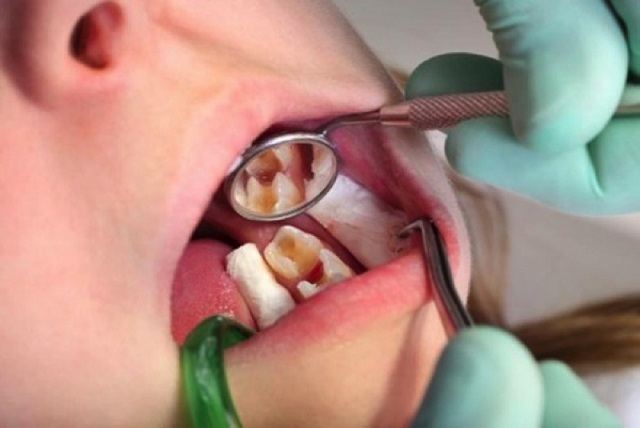 Dấu hiệu để người bệnh nhận biết cần phải chữa tủy răng