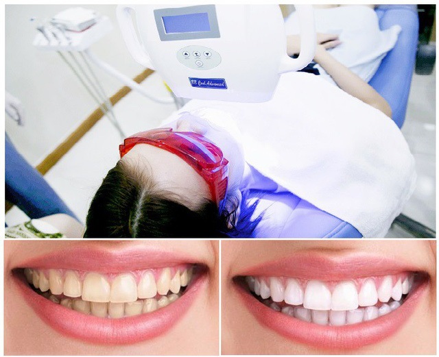 Để có thể nở một nụ cười đầy tươi tắn một cách tự tin thì phải có một hàm răng trắng sáng.