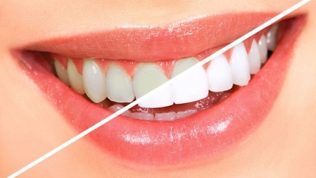 Hàm răng trắng sáng mang đến sự tự tin khi giao tiếp