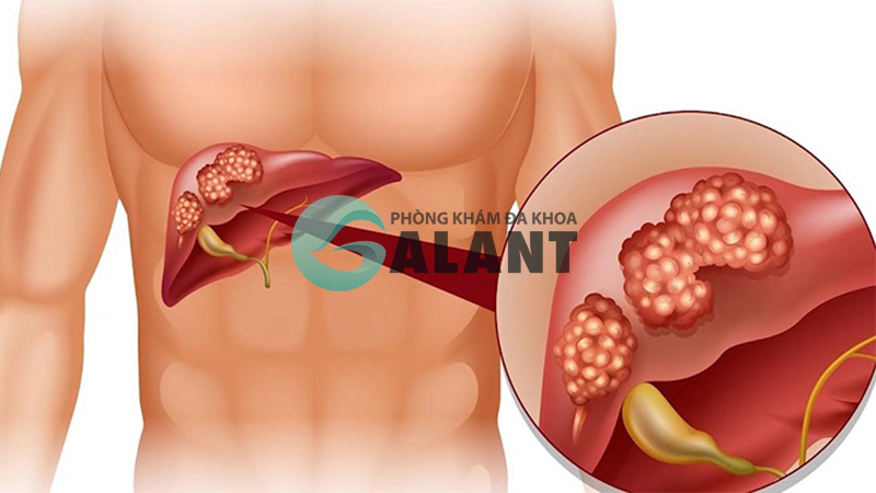 Khả năng lây lan của virus HBV - viêm gan B