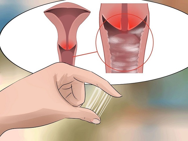 Khí hư ra nhiều bất thường là dấu hiệu bệnh nấm sinh dục