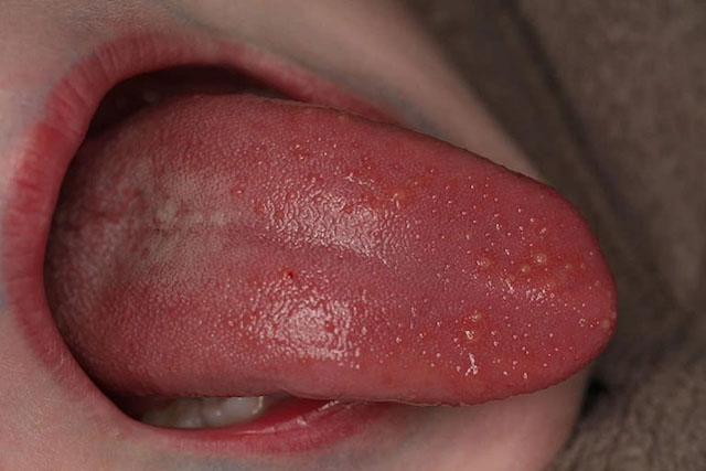 Không chỉ bộ phận sinh dục mà bạn nên để ý cả lưỡi khi bị sùi mào gà ở nữ giới giai đoạn đầu
