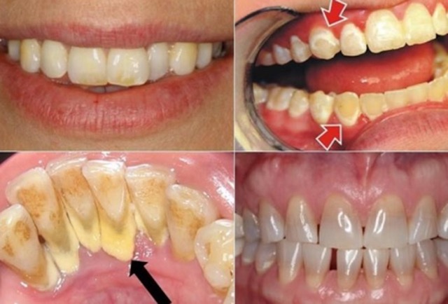 Vôi răng những mảng bám có màu vàng nhạt hoặc vàng sẫm ở thân răng và nướu răng gây ra bệnh về miệng.