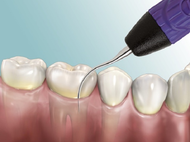Lấy cao răng có ảnh hưởng gì không?