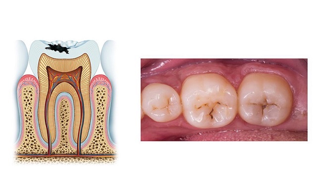 Lối sinh hoạt không lành mạnh tạo cơ hội cho vi khuẩn gây sâu răng phát triển