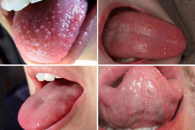 Lưỡi của người bệnh có các đốm trắng li ti