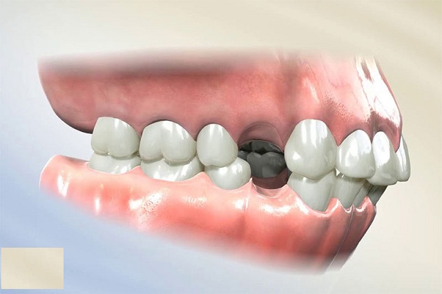 Một số trường hợp khi chỉnh răng thẩm mỹ cũng cần tiểu phẫu nhổ răng trước khi niềng