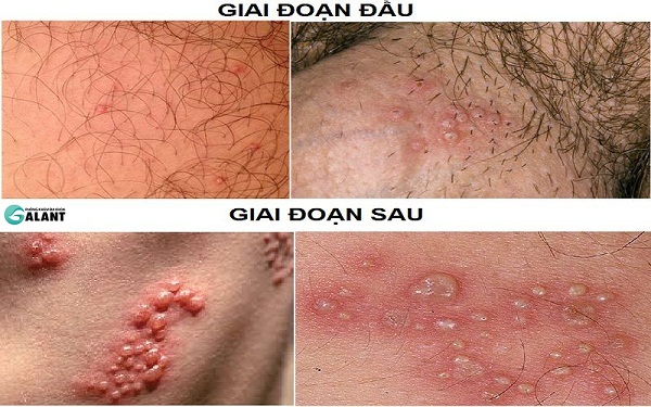 Mụn rộp sinh dục (Herpes sinh dục - Genital Herpes)