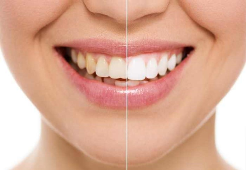 Nếu đang tự ti về hàm răng xỉn màu, bạn có thể tham khảo và đi tẩy trắng răng bằng đèn plasma.