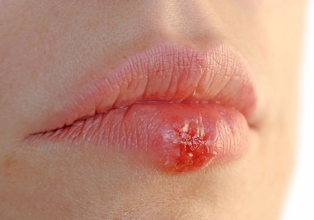 Nguyên nhân bị mụn rộp sinh dục ở miệng là gì?