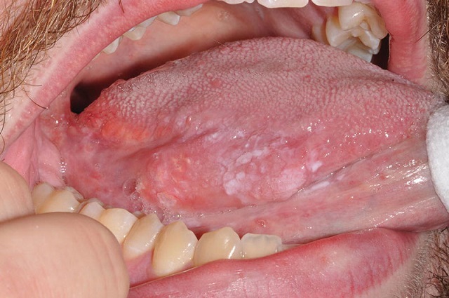 Nguyên nhân gây nên bệnh sùi mào gà xuất hiện ở lưỡi