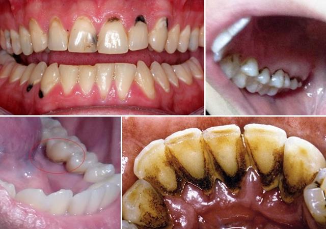 Nguyên nhân gây nên tình trạng răng xỉn màu và nhiễm màu răng