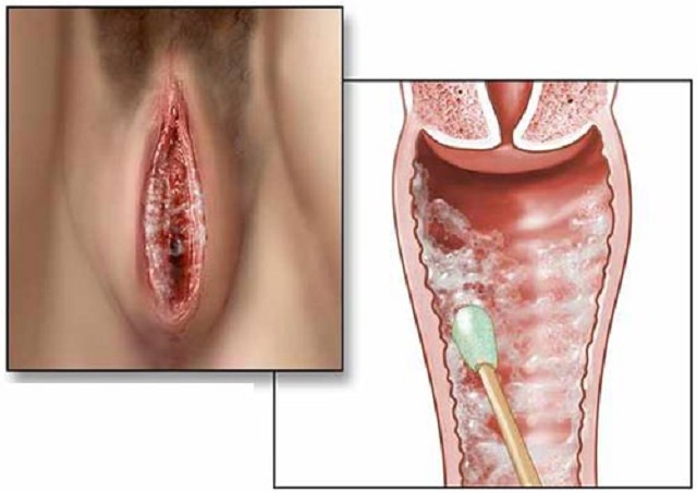 Nhiễm nấm sinh dục là bệnh lý thường gặp ở nữ giới