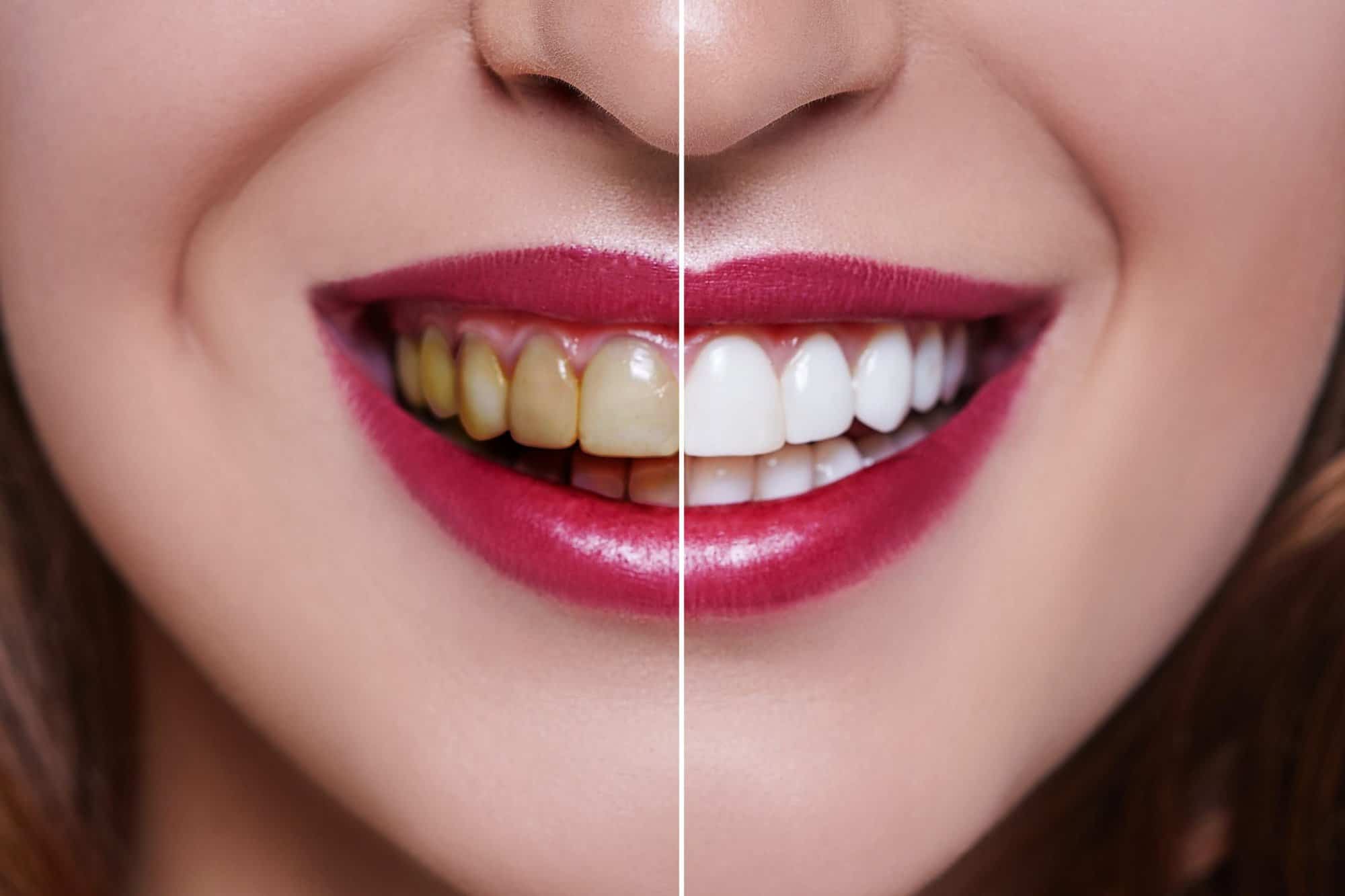 Nhiều bạn lo lắng: tẩy trắng răng có bị vàng lại không?
