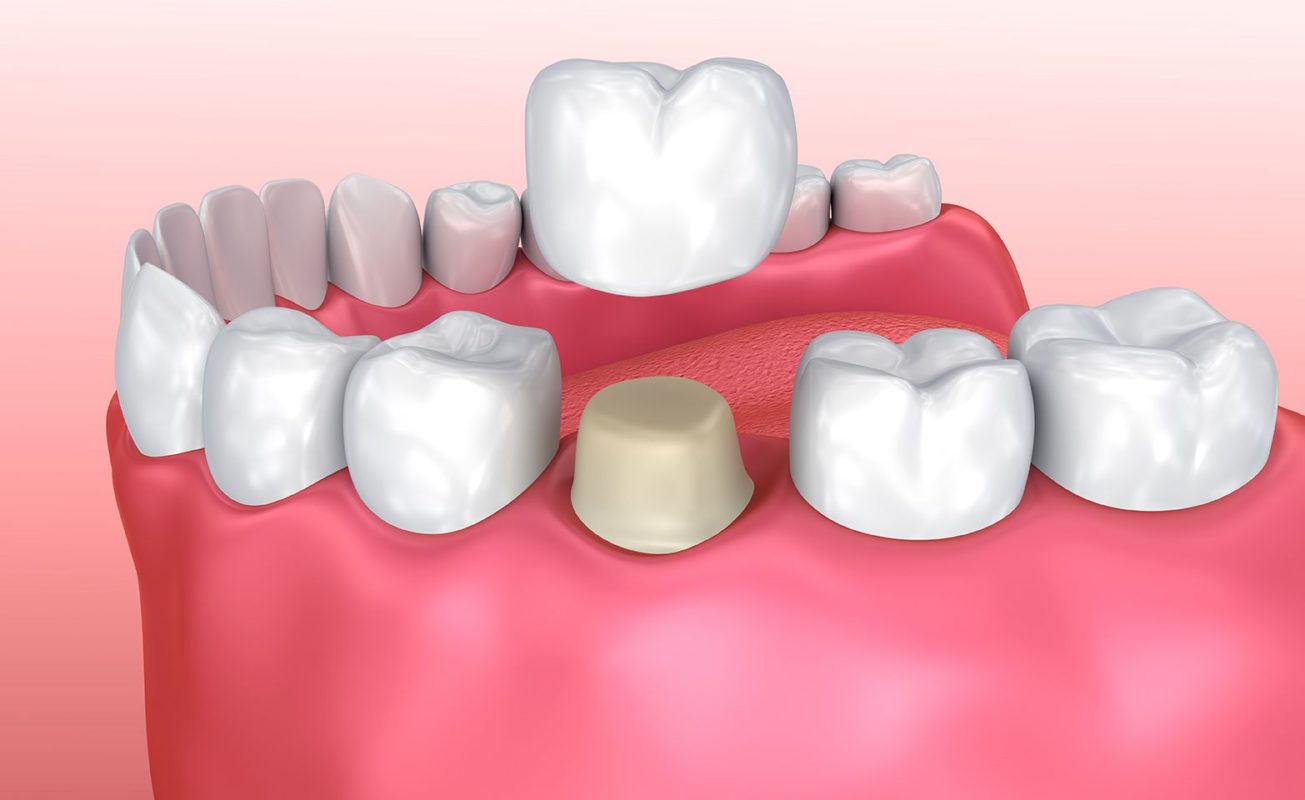 Nhiều bạn thắc mắc: bọc răng sứ có tốt không?