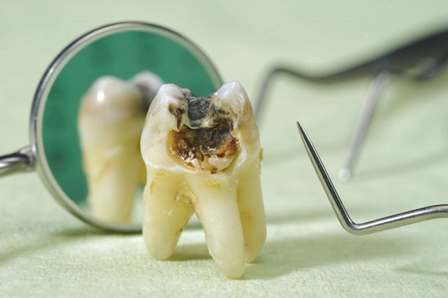 Nhổ răng bị sâu giúp bảo vệ sức khỏe răng miệng
